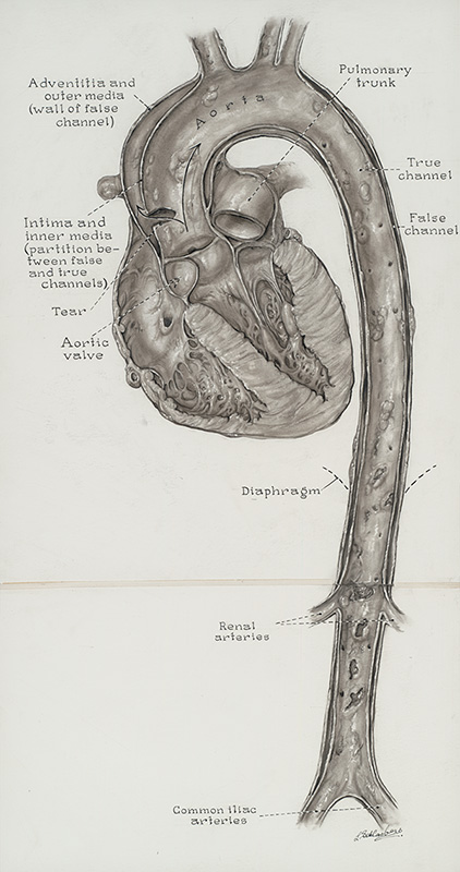 Aortic Surgery | Baylor Scott & White Heart And Vascular Hospital – Dallas