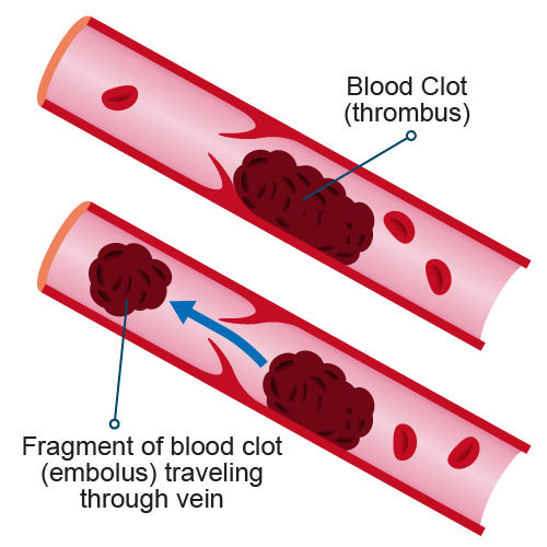 Pulmonary Embolism | Baylor Scott & White Medical Center – Temple