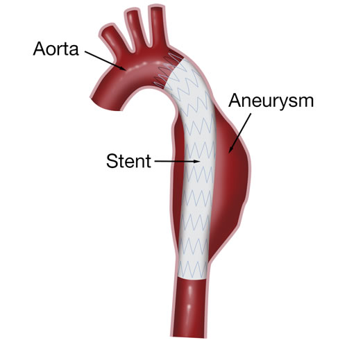 Aortic Program | Baylor Scott & White Medical Center – Temple